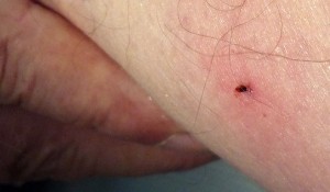 Neues Antibiotikum in Gelform gegen Borreliose