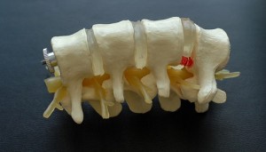 Neue Knochenimplantate mit verbesserter Haltbarkeit
